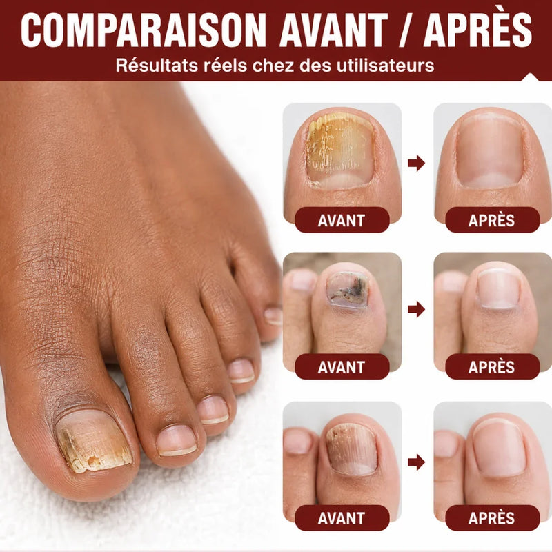 SmartRepair™ - "Protocole 24H" contre les mycoses d'ongles
